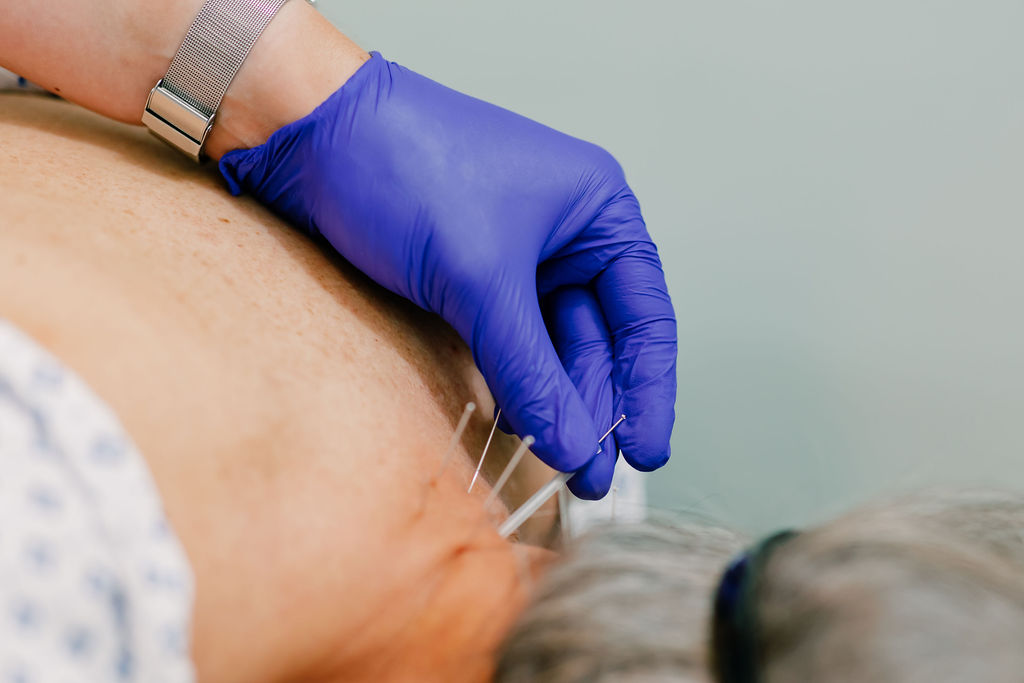 Dry needling in Jacksonville FL, by Dr. Dalton Tolliver at Seven Bridges Chiropractic