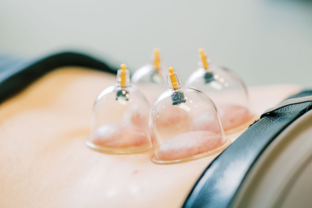 Dr. Datlon providing cupping therapy to patient