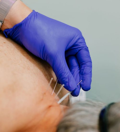 Dry needling in Jacksonville FL, by Dr. Dalton Tolliver at Seven Bridges Chiropractic